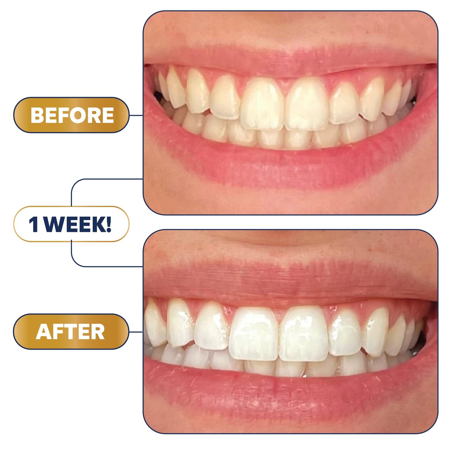 Lumineux Teeth Whitening Strips 21 Treatments – Peroxide Free - Enamel Safe for Whiter Teeth - Whitening Without The Sensitivity - Dentist Formulated - Sensitivity