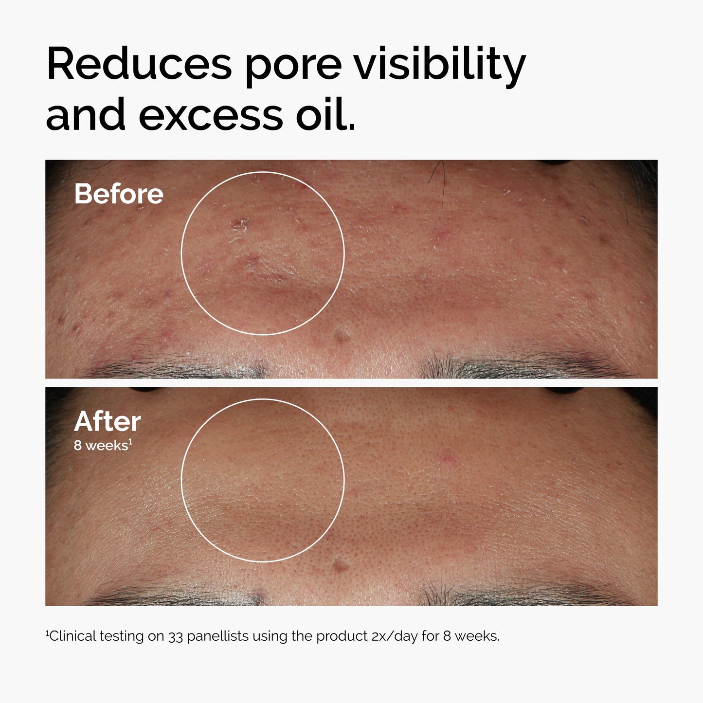 The Ordinary Niacinamide 10% + Zinc 1%, Smoothing Serum for Blemish-Prone Skin, 1 Fl Oz